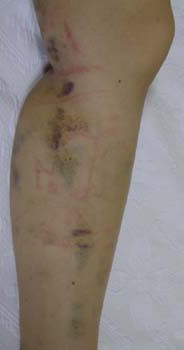 Radyofrekansla varis tedavisinde bacak görünümü 