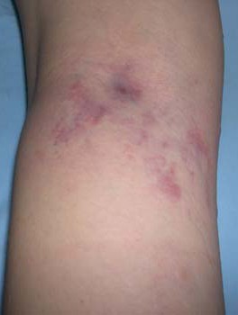 Varis tedavisinden sonra bacakta kızarma olabilir